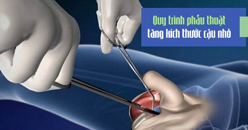 Quy trình phẫu thuật tăng kích thước cậu nhỏ